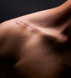 טשטוש והעלמת צלקות - תמונת אווירה